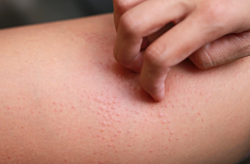 Skin Eczema 